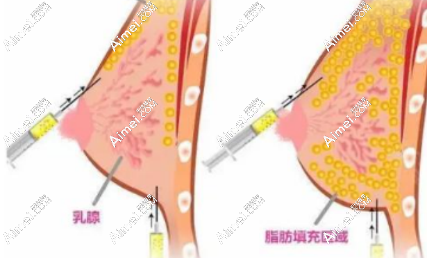 脂肪丰胸 脂肪丰胸