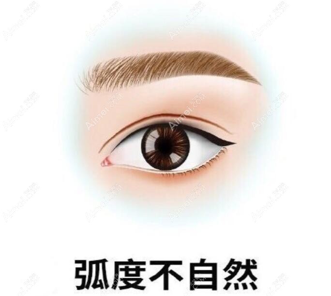 卢尚兵做过双眼皮的说说