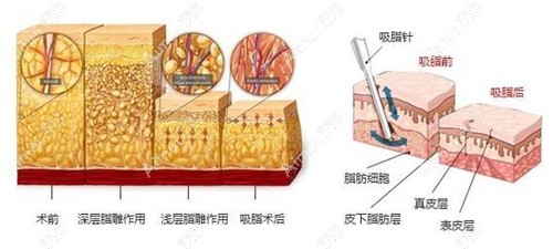 沈阳吸脂好的医院手术原理