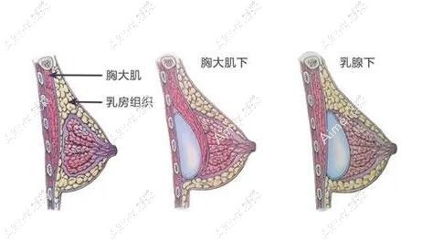 徐国建IMF舒适丰胸 徐国建IMF舒适丰胸