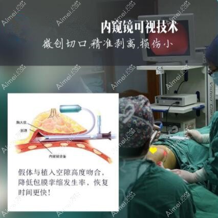 徐国建医生的隆胸技术优势 徐国建医生的隆胸技术优势