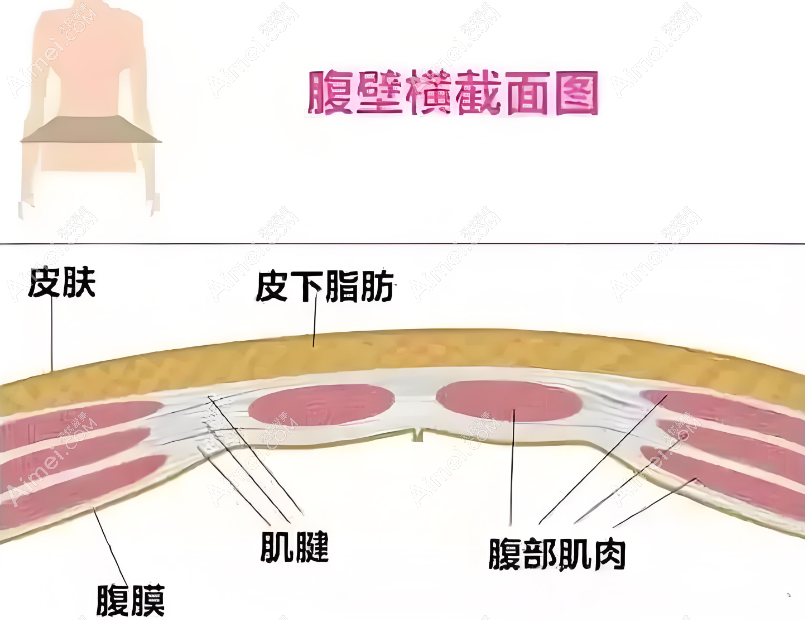 腹壁整形术 腹壁整形术
