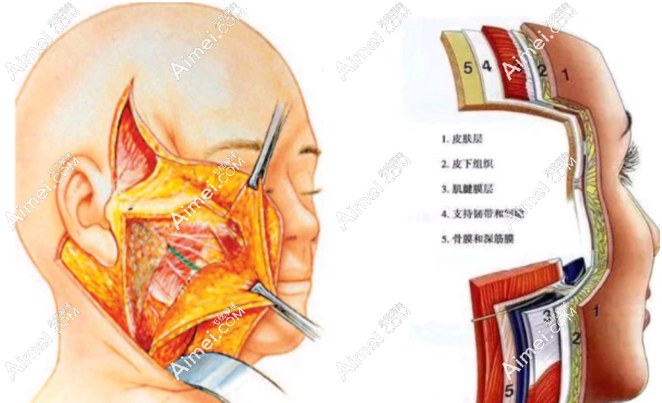 dlren.com拉皮示意图