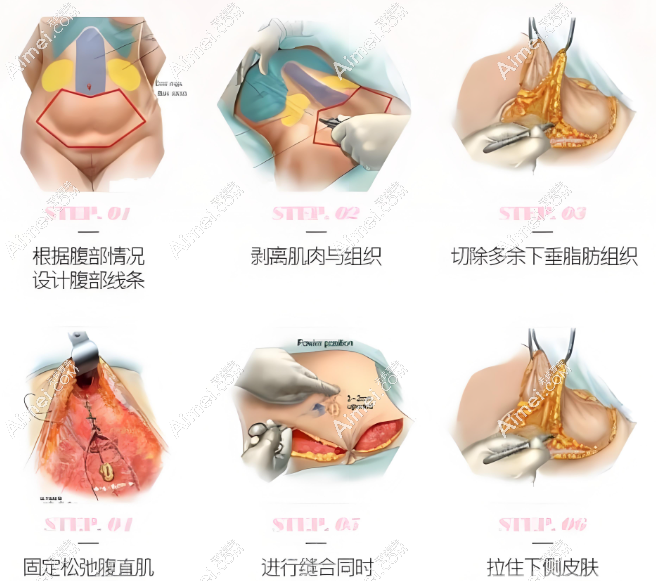 李献和腹壁成型怎么样 李献和腹壁成型怎么样