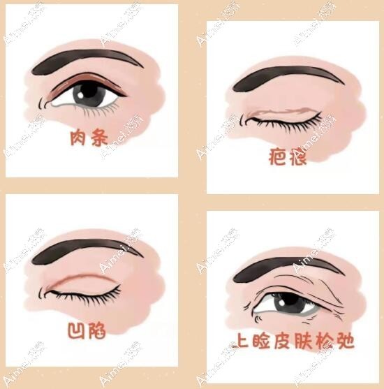 大连割双眼皮失败修复好的医生排名:刘志刚/吴紫权/张井忠排前十-眼修复技术一绝