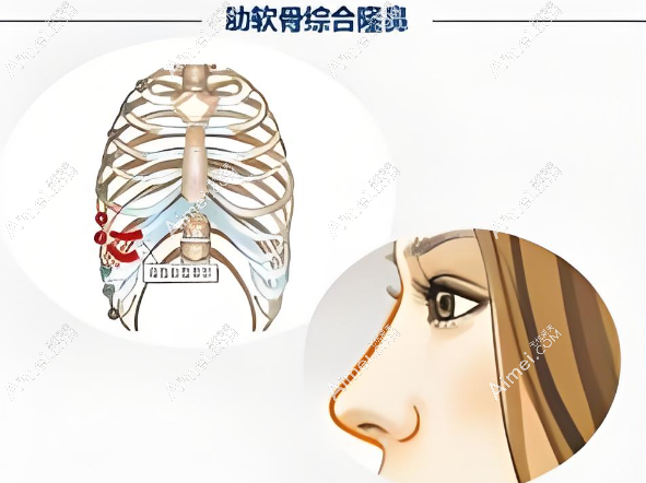 鼻整形手术 鼻整形手术