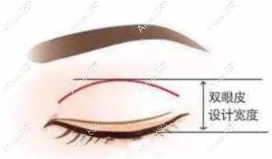 陈贵宗医生割双眼皮技术评价好