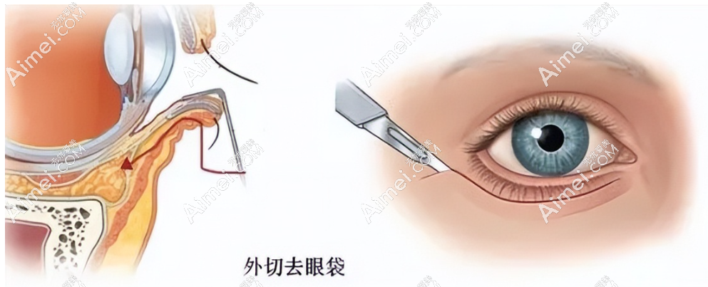 医美袁强外切眼袋靠谱吗?挺靠谱的,对于袁强医生来说这是个小手术,均价8k