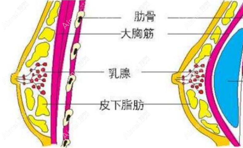 罗盛康隆胸技术好排名国内前十,属于福田区有名的隆胸医生