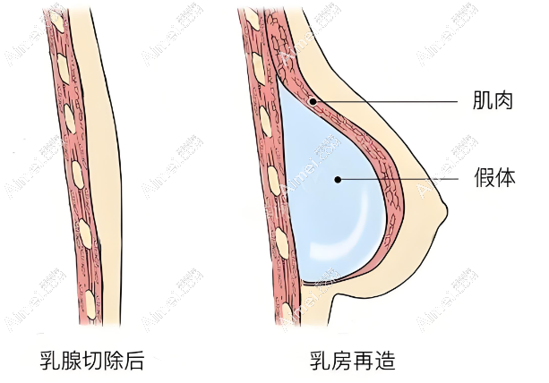 国内乳房再造手术已经比较成熟 国内乳房再造手术已经比较成熟