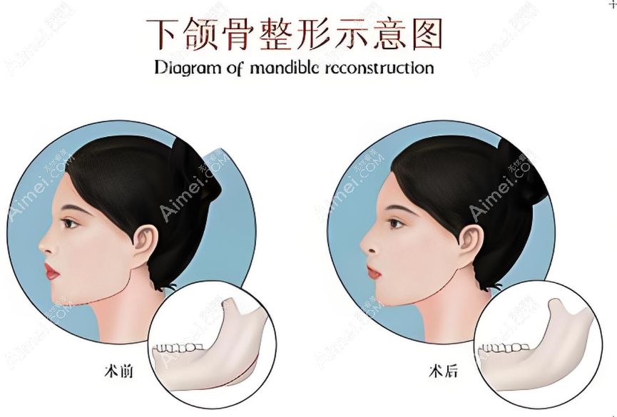罗恩磨骨正颌几乎没有失败实例www.dlren.com