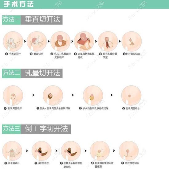 曾昂医生做缩胸手术的原理图 曾昂医生做缩胸手术的原理图