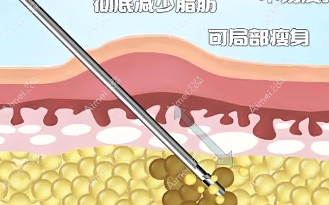 孙波吸脂是先预约还是直接去就可以吗?得先预约,直接去有可能见不到人