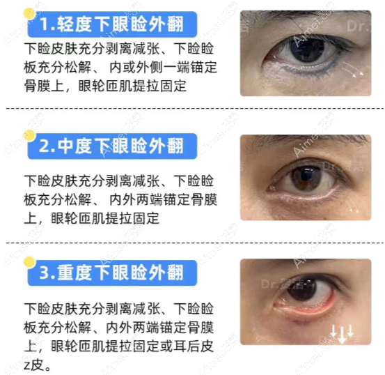 国内修复下眼皮外翻好的医生排名 国内修复下眼皮外翻好的医生排名