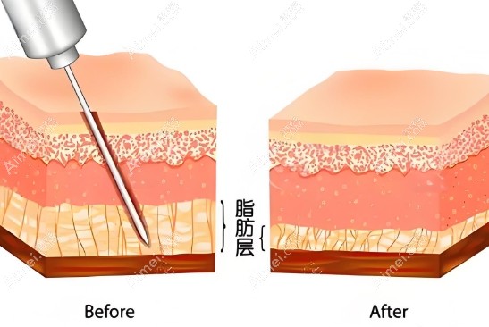 孙波吸脂的口碑和评价www.dlren.com 孙波吸脂的口碑和评价www.dlren.com