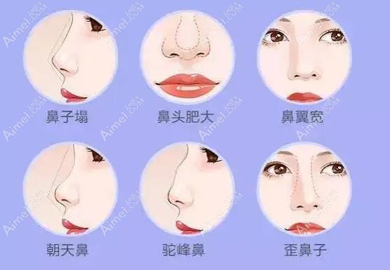 杭州艺星张龙做鼻子价位贵吗 杭州艺星张龙做鼻子价位贵吗