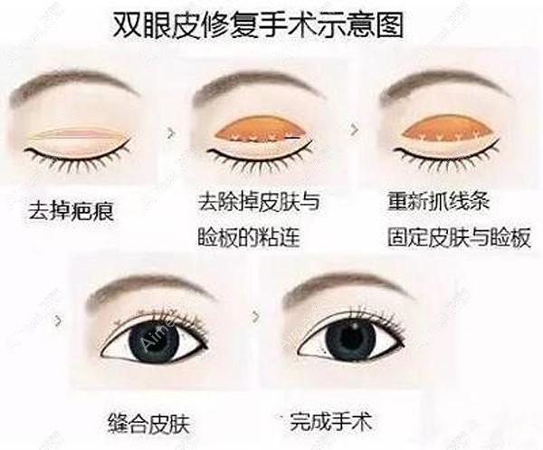 郑小红医生做双眼皮修复的原理图 郑小红医生做双眼皮修复的原理图