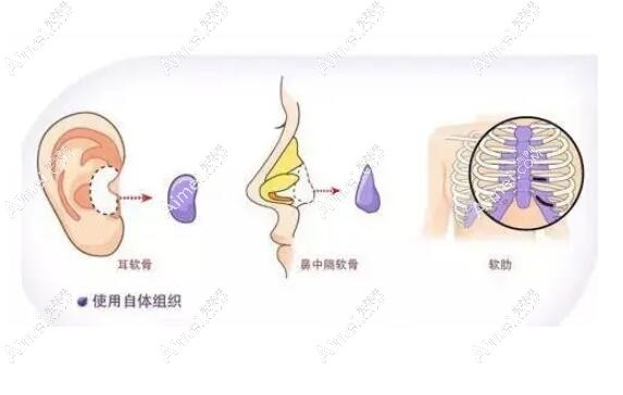 杭州艺星张龙做鼻子怎么样 杭州艺星张龙做鼻子怎么样