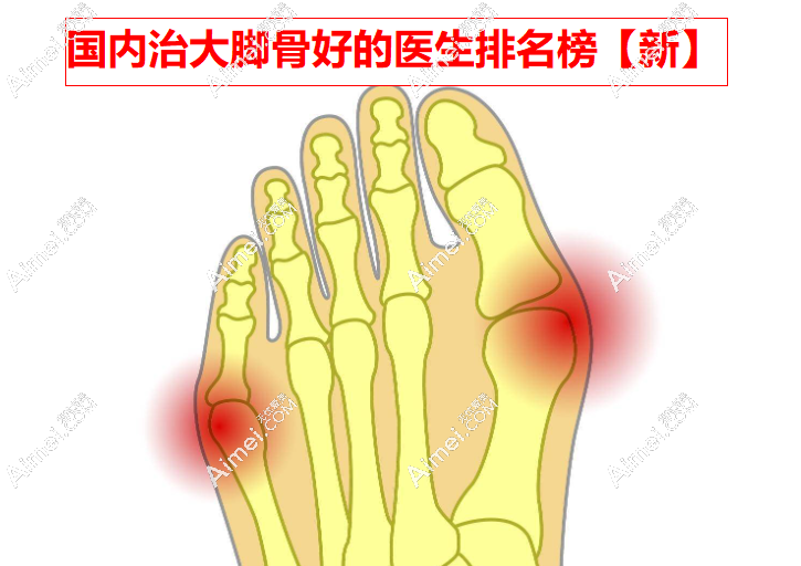 国内治大脚骨好的医生排名榜【新】,苏敬达/马桂文/李茂盛热度奇高,位列前三