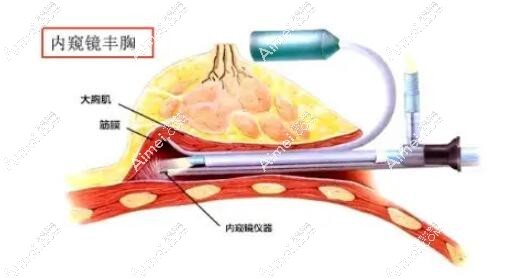 赵敬国医生隆胸怎么样