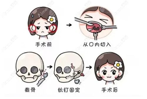 成都李继华磨骨怎么样 成都李继华磨骨怎么样