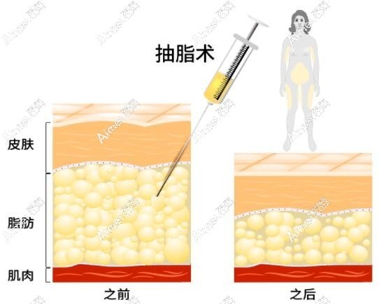 张平院长多维立体腰腹吸脂真人体验评价 张平院长多维立体腰腹吸脂真人体验评价