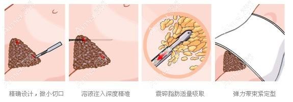 国内腰腹环吸医生排名前十更新名单 国内腰腹环吸医生排名前十更新名单