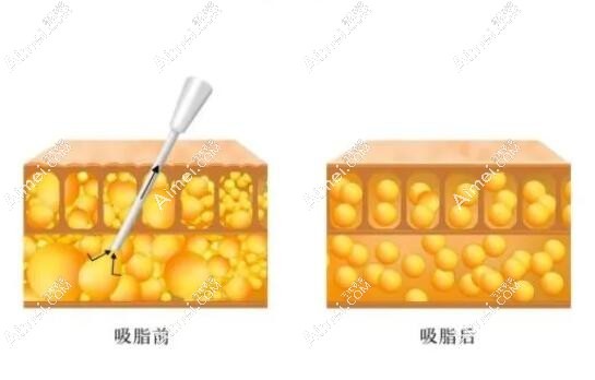 成都腰腹部环吸抽脂医院排名前十出炉:军大、怡脂等吸脂技术口碑好的医院上榜 成都腰腹部环吸抽脂医院排名前十出炉:军大、怡脂等吸脂技术口碑好的医院上榜