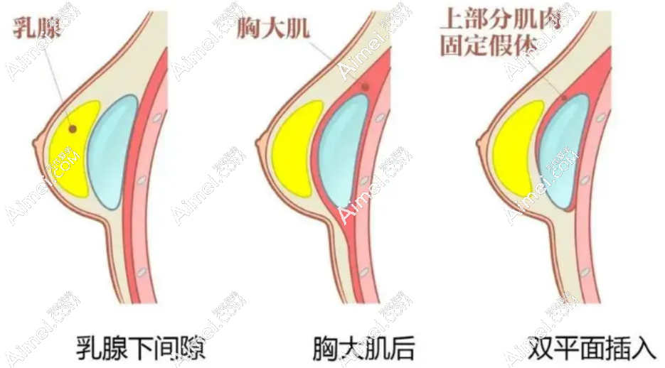 dlren.com深圳顾伟明医生隆胸