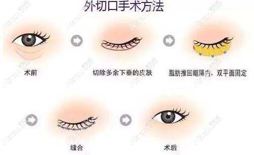 南宁去眼袋口碑好的医院手术方式 南宁去眼袋口碑好的医院手术方式