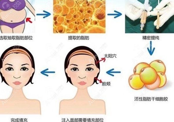 重庆松山医院整形科做脂肪填充面部很棒 重庆松山医院整形科做脂肪填充面部很棒