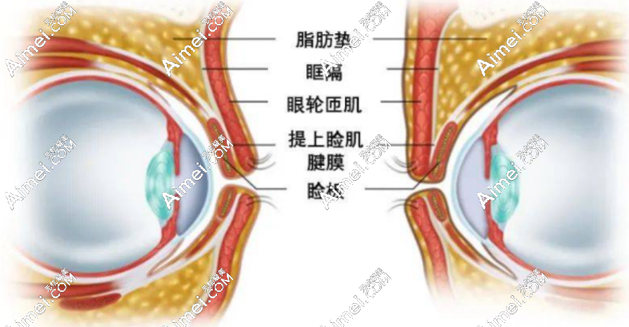 双眼皮手术