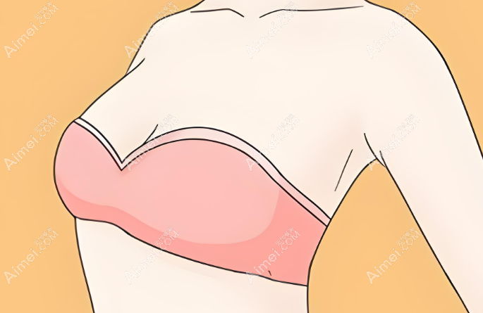 孙湄杨假体隆胸手术失败修复实例 孙湄杨假体隆胸手术失败修复实例