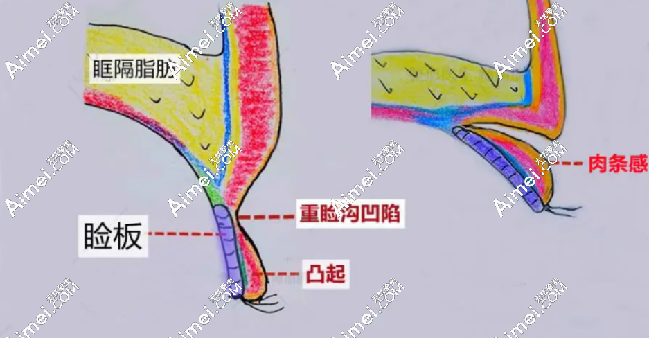 双眼皮手术
