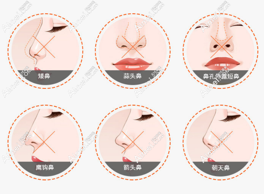隆鼻示意图 隆鼻示意图