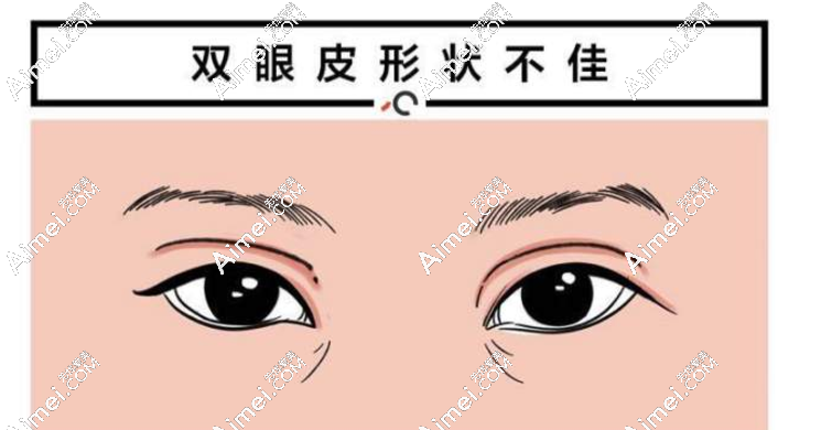 郑小红双眼皮避雷还是种草?修复双眼皮没爆出过黑料超靠谱,我先种草了