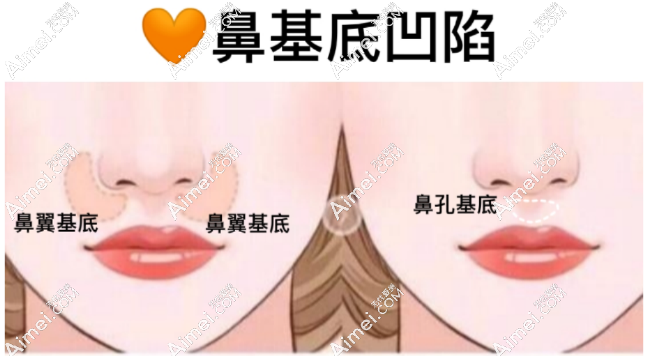 隆鼻示意图 隆鼻示意图