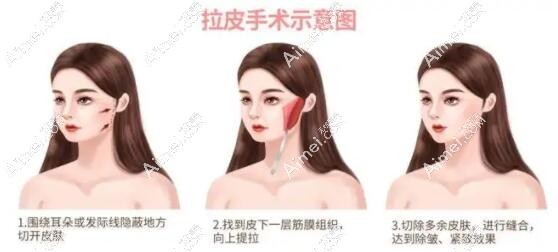 深圳南雅刘富增医生拉皮怎么样? 深圳南雅刘富增医生拉皮怎么样?