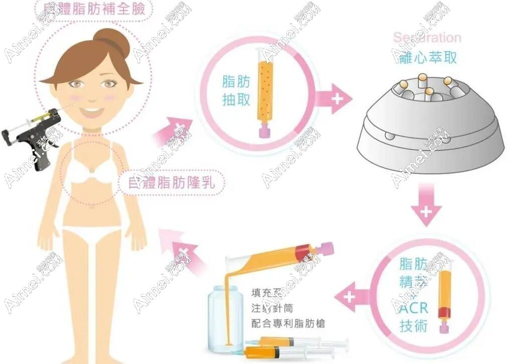 2024年北京自体脂肪隆胸价格在3万-6万元起 2024年北京自体脂肪隆胸价格在3万-6万元起