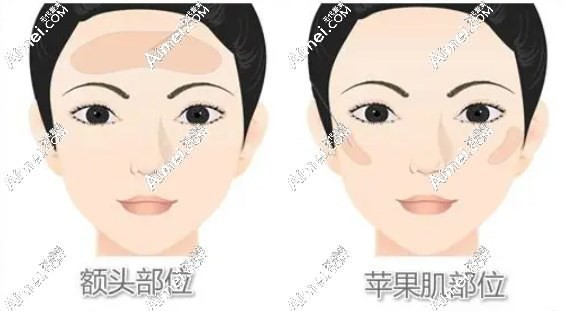 北京纯脂王自谦填充价格 北京纯脂王自谦填充价格