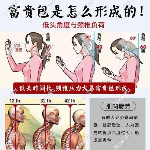 北京有没有治富贵包的医院.jpg 北京有没有治富贵包的医院.jpg