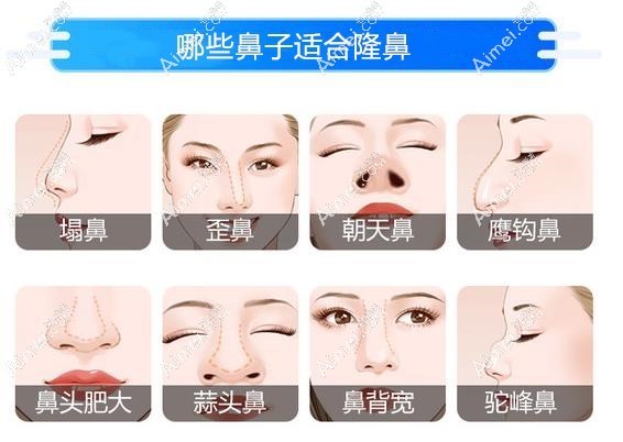 北京隆鼻特色整形医院哪家好 北京隆鼻特色整形医院哪家好
