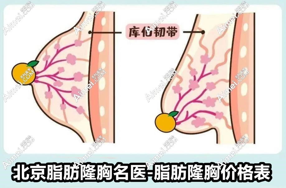 北京脂肪隆胸医生排名 北京脂肪隆胸医生排名