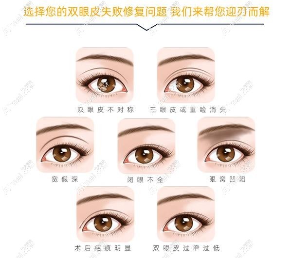 北京双眼皮及眼修复医院哪家好 北京双眼皮及眼修复医院哪家好