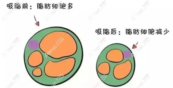 北京吸脂特色机构排名推荐 北京吸脂特色机构排名推荐