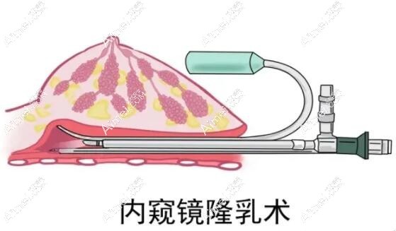 何贤清擅长内窥镜假体隆胸手术技术超好 何贤清擅长内窥镜假体隆胸手术技术超好