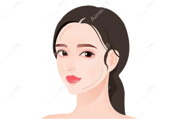 成都刘远程无痕筋膜提升手术实例www.dlren.com