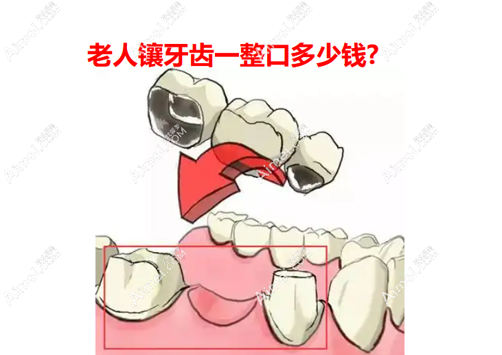 老人镶牙齿一整口多少钱www.dlren.com 老人镶牙齿一整口多少钱www.dlren.com