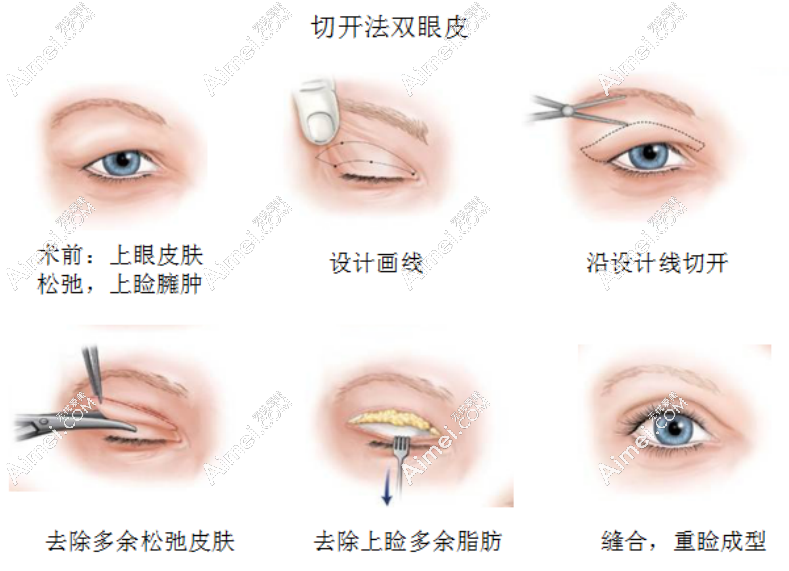 郑永生医生做双眼皮手术 郑永生医生做双眼皮手术