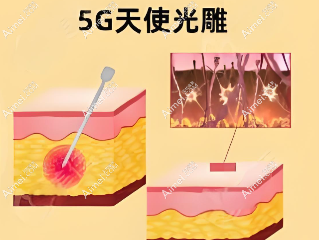 5g天使光雕吸脂价格近6个月市场均价35000元(不是智商税噱头,起效快维持时间长)